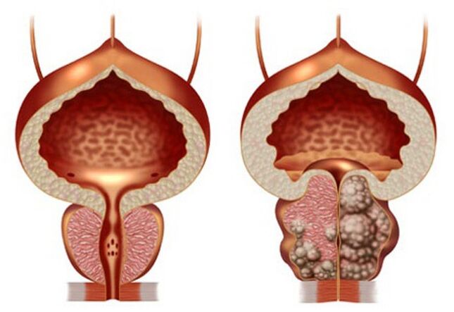 prostate saine et adénome de la prostate