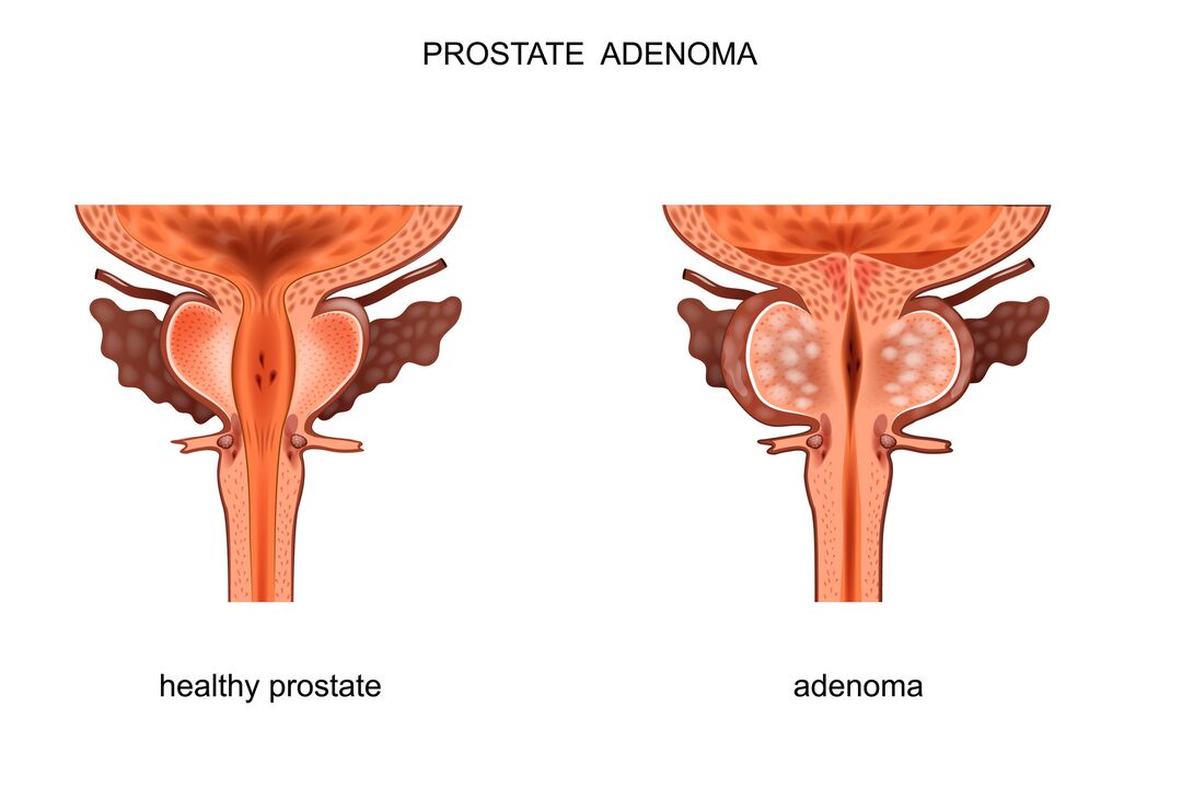 prostate saine avec adénome